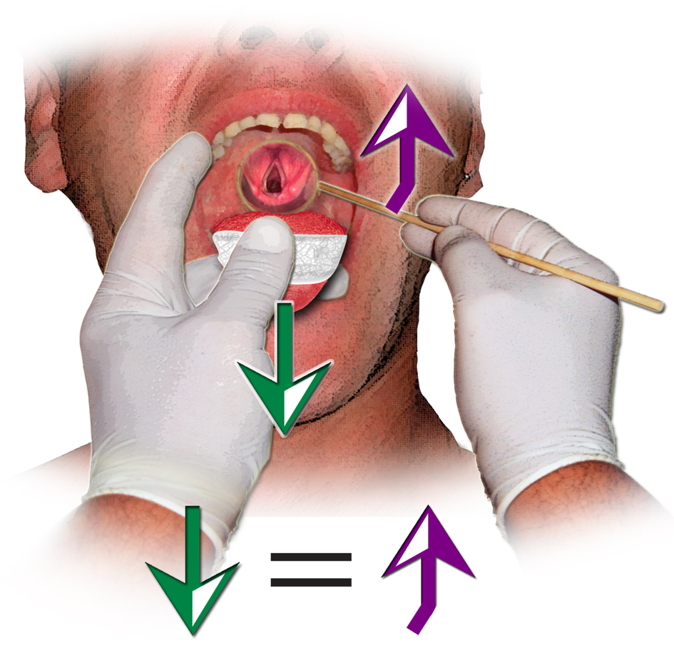 HOW WE DO IT AN IMPROVED TECHNIQUE OF INDIRECT LARYNGOSCOPY
